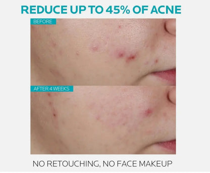 La Roche-Posay Effaclar Salicylic Acid Acne Treatment Serum – 30ml (1.0 fl. oz.) Daily Clarifying Exfoliator NORTH WAVE   SCENTORA