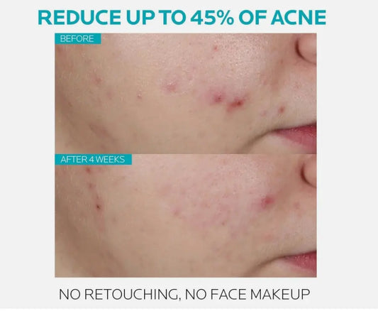 La Roche-Posay Effaclar Salicylic Acid Acne Treatment Serum – 30ml (1.0 fl. oz.) Daily Clarifying Exfoliator NORTH WAVE   SCENTORA